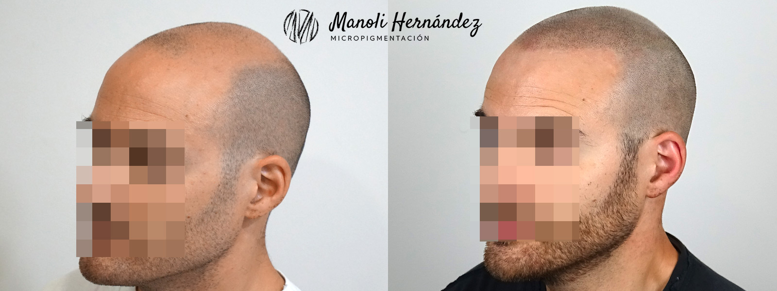 Tratamiento de micropigmentación capilar para tratar alopecia