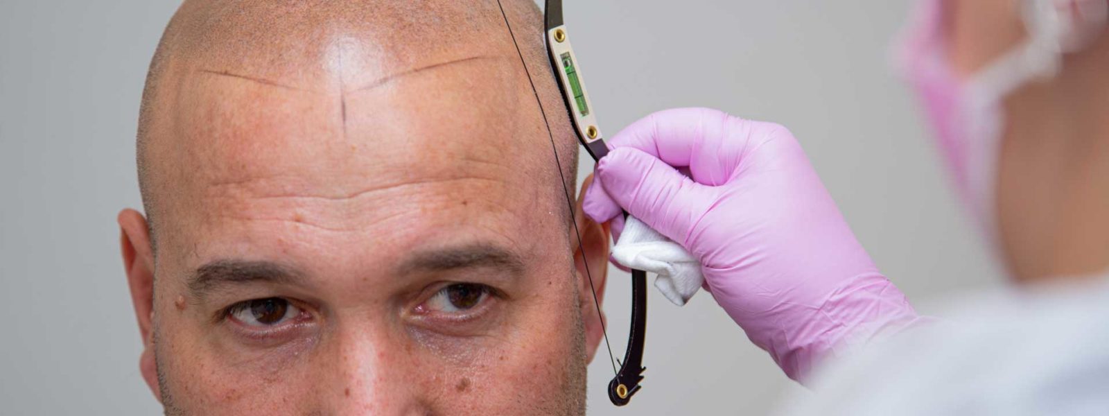 Diseño frontal de micropigmentación capilar en Barcelona