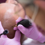 Micropigmentación capilar en Barcelona para alopecia